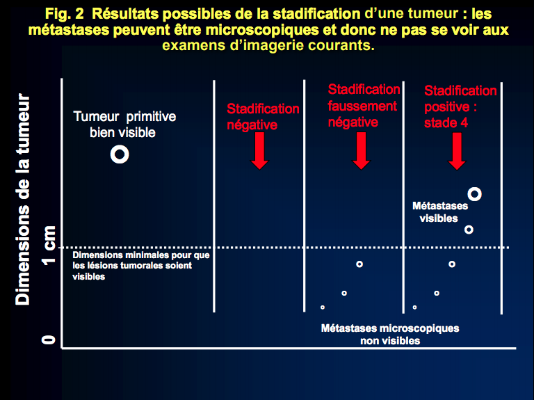 2-Résultats possibles de la stadification d’une tumeur : les métastases peuvent être microscopiques et donc ne pas se voir aux examens d’imagerie courants.